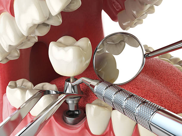Best Emergency Dental Care for Broken or Chipped Teeth in Pixley, CA